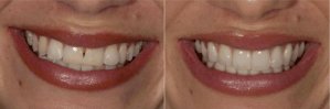 conditions that porcelain veneers can correct